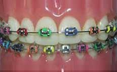 Metal-braces-color_1