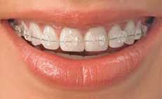 Clear-braces_1