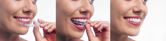 Invisalign