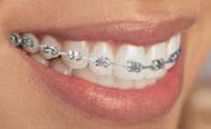 Metal-Braces-1_1